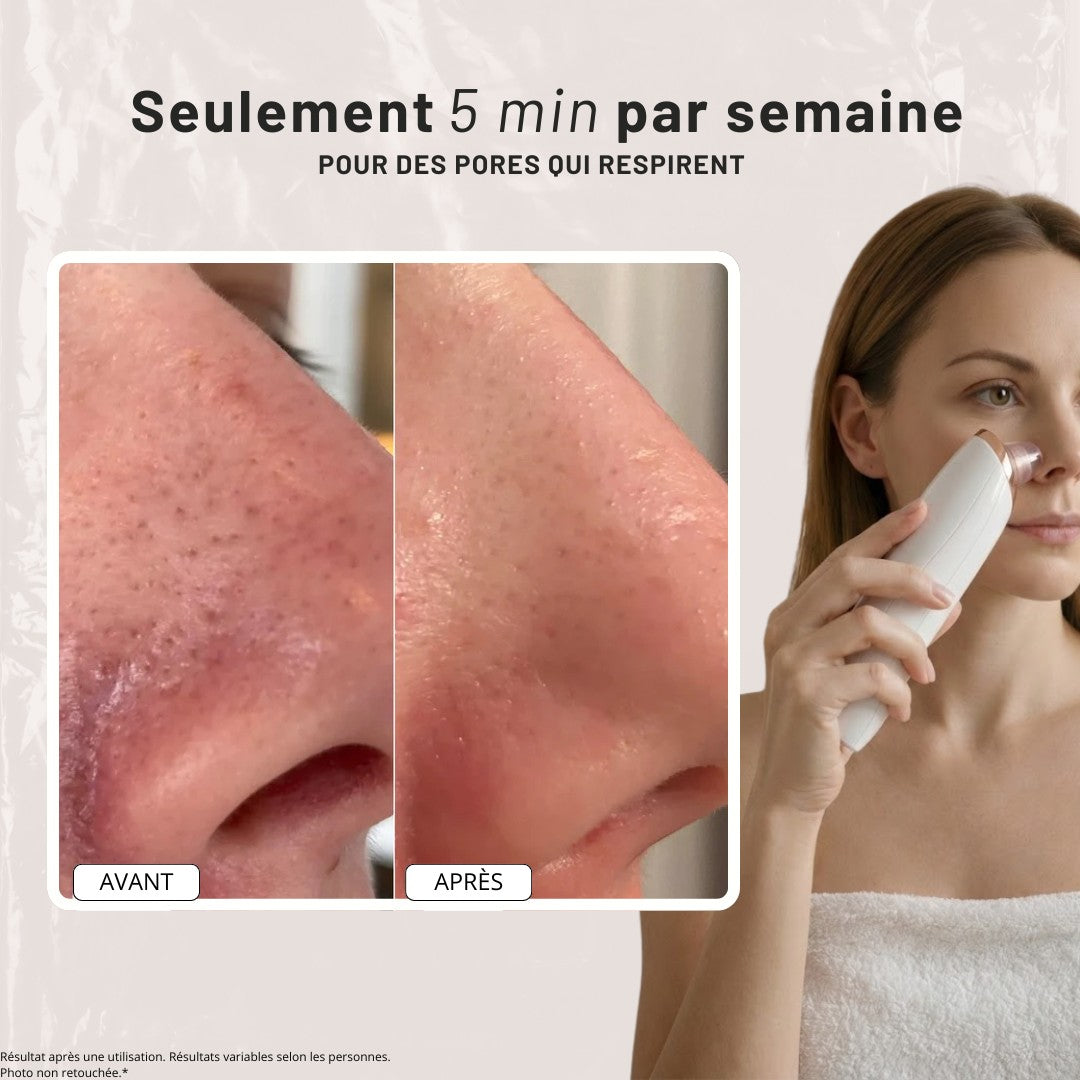 Aspirateur dermatologique pour points noirs